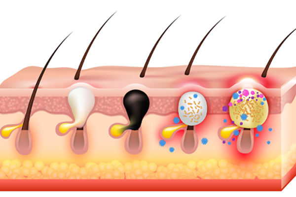 Kıl kökü iltihabı (Folikülit) neden olur? Ne iyi gelir?
